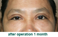 plastic-surgery-blepharoplasty